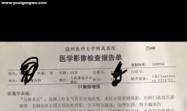右肺上叶切除，术前术后对比