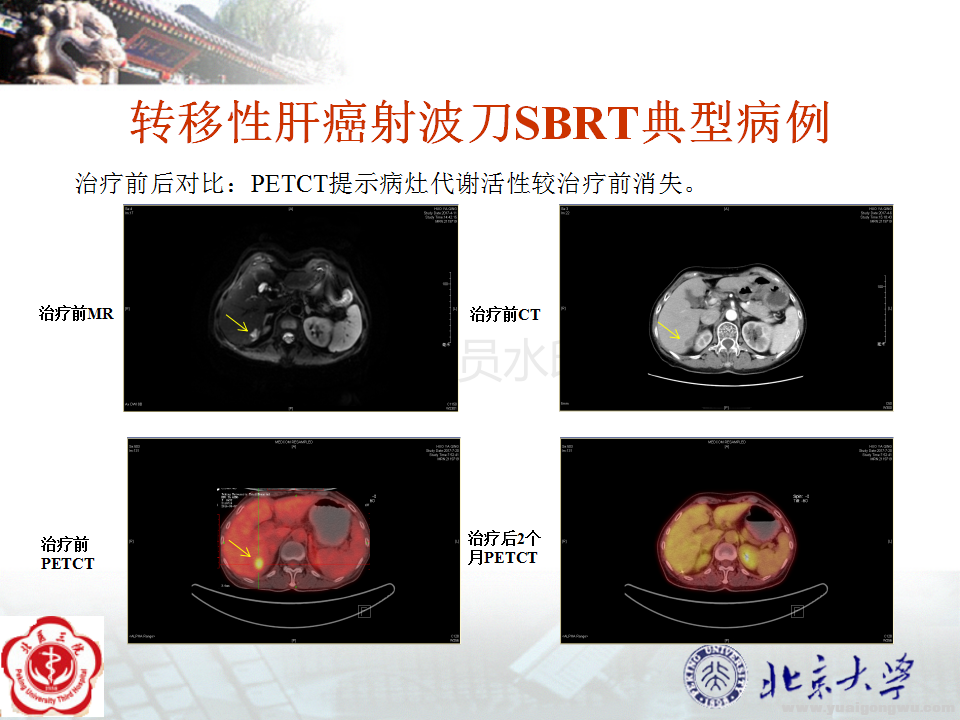 转移性肝癌典型病例_02.png