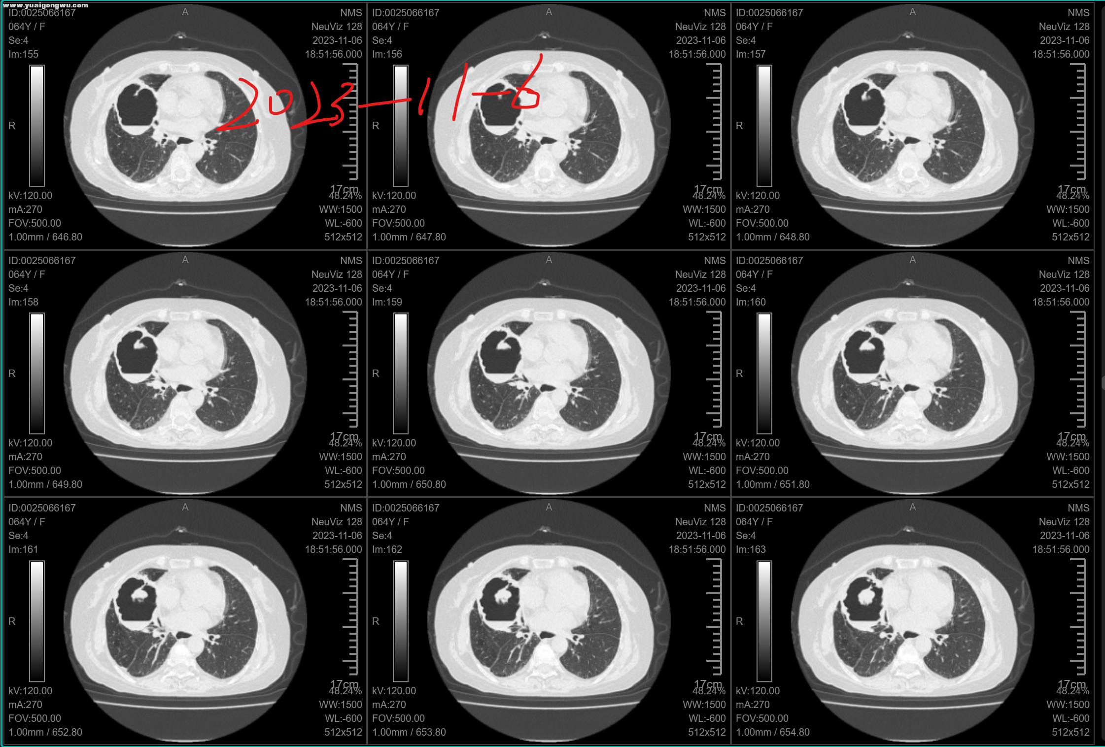2023年11月6日CT图像